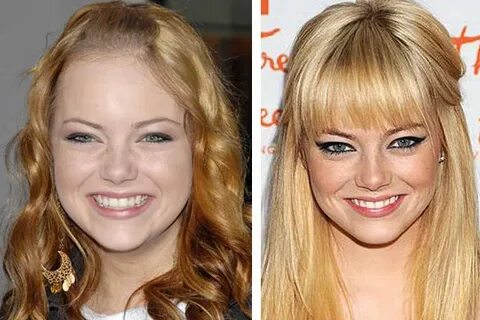 Emma Stone Nose Job Plastic Surgery Before and After Photos 
