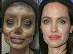 Teen's botched Angelina Jolie plastic surgery roils internet