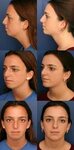 Chin Augmentation Before After Pictures - Dr. Ronald Schuste