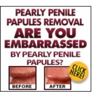 How To Get Rid Of Pearly Penile Papules (bumps) In 3 Days " 