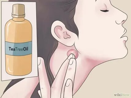 How to Treat an Infected Sebaceous Cyst Cyst acne, Essential