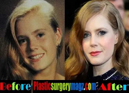 Amy Adams Plastic Surgery Before and After Pictures Plastic 