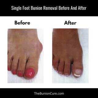 Pin on The Bunion Cure