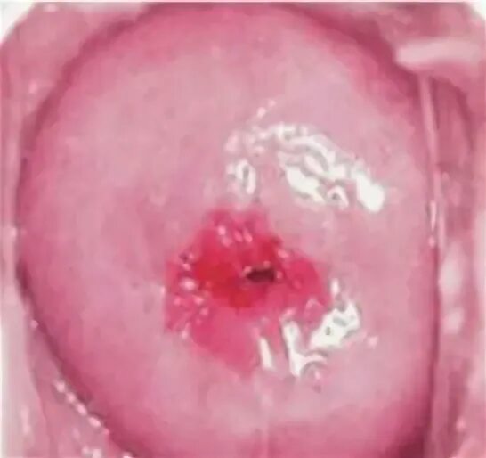 Leucorrhoea and Cervical Erosion