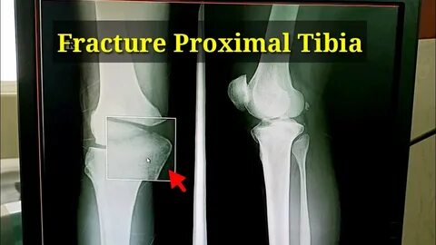Fracture Tibial Plateau Proximal Tibia Fracture X-ray Knee J