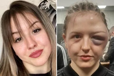 Boxer Cheyenne Hanson left with horrific swollen face after 