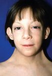A 7-year-old girl with pterygium colli associated with Turne