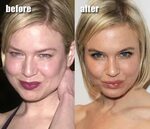 Renee Zellweger Plastic Surgery Before and After - Celeb Sur