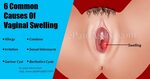 6 Common Causes Of Vaginal Swelling