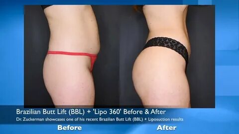 Brazilian Butt Lift (BBL) + 'Lipo 360' Before & After - YouT