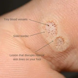 What Causes Plantar Warts And How Can I Get Rid Of Them