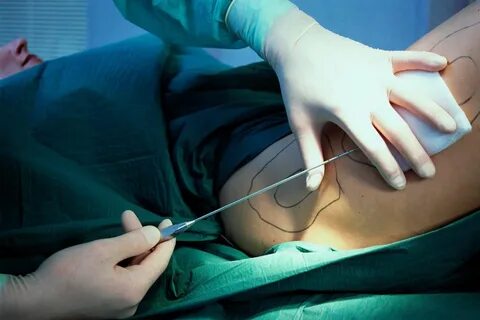 Liposuction Care After Surgery.