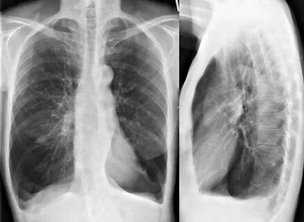 Flecken lunge röntgenbild Schatten im Bereich der Lunge im R