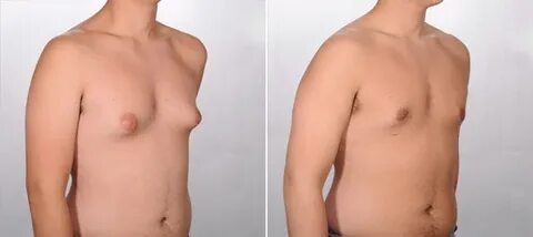 Gynecomastia - Male Breast Reduction in Metro Detroit Strait