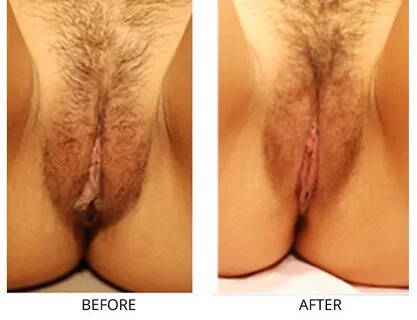 Labiaplasty In Manhattan, NYC - Labiaplasty NYC - Labiaplast