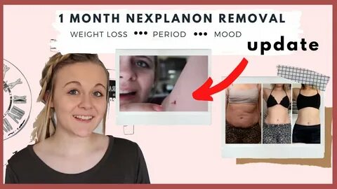 1 month nexplanon removal update - YouTube