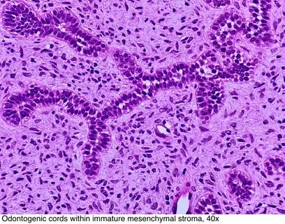 Pathology Outlines - Ameloblastic fibroma