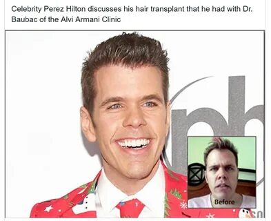 Perez Hilton hair transplant with Dr. Baubac ALVI ARMANI BEV