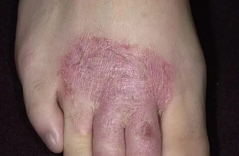 Dermatologi: Psoriasis Tangan dan Kaki (termasuk Pustulosis 