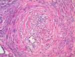 Leiomyosarcoma Uterus Pathology Outlines - Pathology Outline