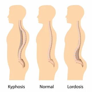 Austin, TX Kyphoplasty Spinal Surgery: Treating Vertebrae Co
