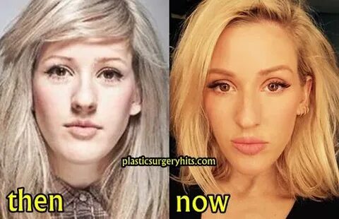 Ellie Goulding Plastic Surgery Fact or Rumor - Plastic Surge