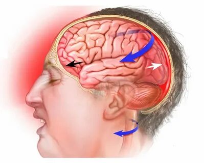 MIN - Traumatic brain injury (TBI, brain concussion or contu