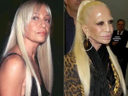 20 Worst Cases Of Celebrity Plastic Surgery Gone Wrong Bad c