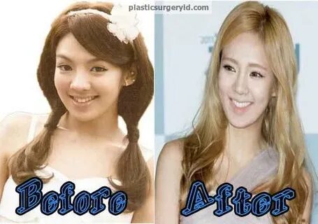 Hyoyeon-SNSD-Plastic-Surgery-Before-and-After-Photo - Journe
