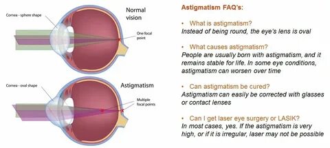 Astigmatism - The Eye Practice