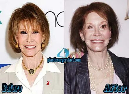 Mary Tyler Moore Archives - Plastic Surgery Facts