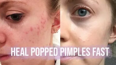 HOW TO HEAL A POPPED PIMPLE FAST - YouTube