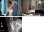 Radiographic and arthroscopic evaluation of glenoid and hume