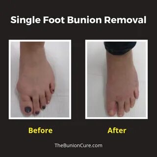Before and After Bunion Surgery Photos Bunion cure, Bunion s