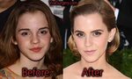 Emma Watson Plastic Surgery, Before and After Nose Job Pictu