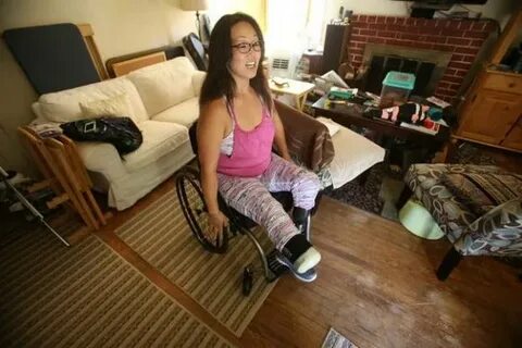 For Bay Area amputees, getting new prostheses a huge headach