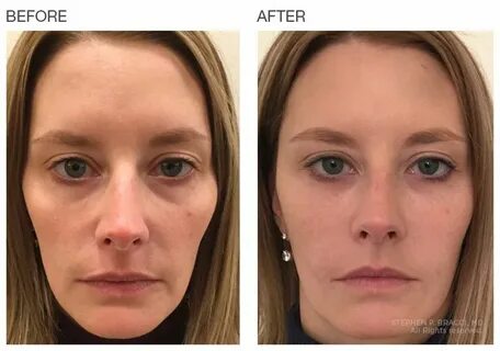 Before & After Baselift Non surgical facelift, Plastic surge