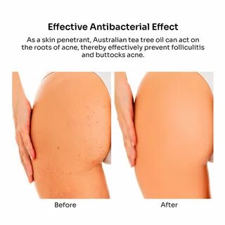 acne on the buttock Promotions