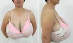 Chinese woman who has gigantomastia has one stone of tissue 