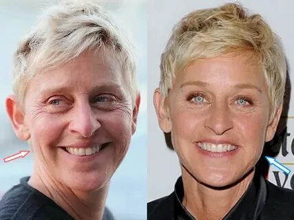 Does Ellen DeGeneres Have Plastic Surgery?