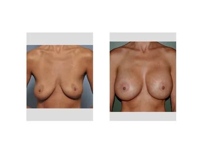 Case Study: Shaped Breast Implant Augmentation - Explore Pla