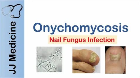 Onychomycosis signs and symptoms Archives - Toenail Fungus