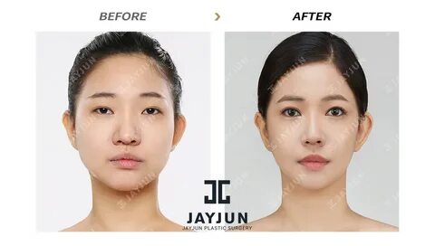 korean eye laser surgery korean eye bag removal korean eye l