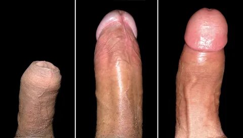 File:Ventral and Dorsal View of Penis.jpg - Wikipedia