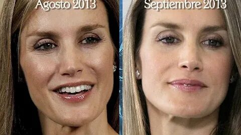 Las fotos del antes y el después de las operaciones estética