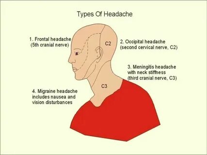 Pin by LudneyJP on Health issues Frontal headache, Headache 
