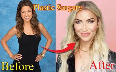 Kaitlyn Bristowe Plastic Surgery - Get All Facts Here Idol P