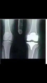 My Biomet knee replacement - Imgur