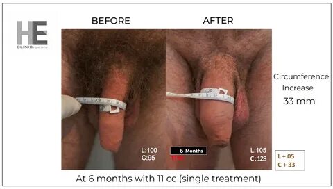 Before after pictures penis enlargement Male Enhancement Cli