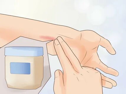 3 Ways to Treat a Small Burn - wikiHow